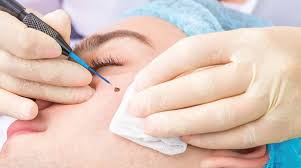 Electrocauterization