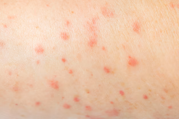 Keloid/Scar Treatment