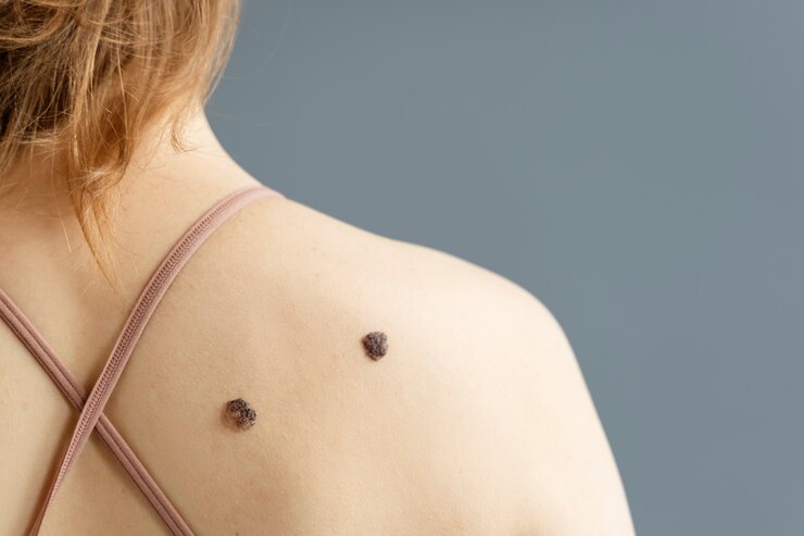 Skin Tag Treatment